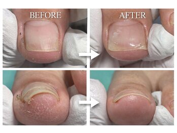 巻き爪補正店 大曽根店/陥入爪補正(初回と7回目)