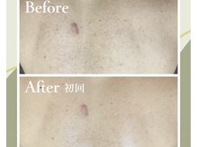 ルミナ(Lumina)の雰囲気（背中にきびや毛穴詰まり、ざらつきに。敏感肌の方でも安心◎）