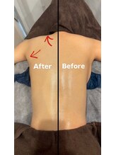 コスメティックス シミズ(SHIMIZU)/ハイパーナイフ1回