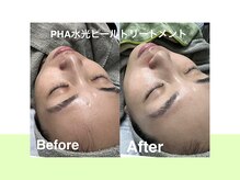 スキンラボ ドットシキブ 厚木海老名店(skinlabo .sikibu)/ビフォーアフター