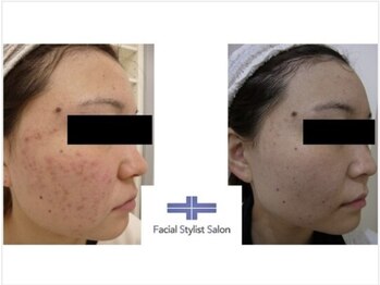 フェイシャルスタイリストサロン 四谷店/ケア例(37)