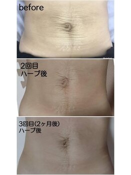 サロンドカメリア(salon de Camellia)/妊娠線や皮膚のたるみを改善