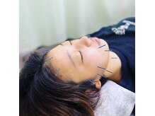 ヒューマン鍼灸接骨院の雰囲気（痛みの少ない美容鍼◎鍼のスタートにオススメ♪）