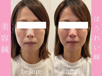 ビープラス(BEE PLUS)/ほうれい線、フェイスライン