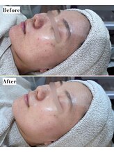 ソワナ(soina)/【神楽坂駅/フェイシャル/毛穴】