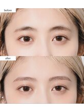 ラキ(LAKI)/HBL ビフォーアフター