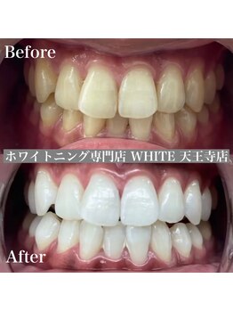 ホワイト 天王寺店(White)/Whitening症例before→after