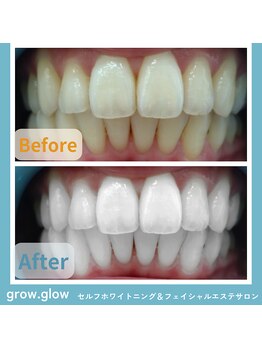 グロウ グロウ(grow.glow)/仙川ホワイトニング