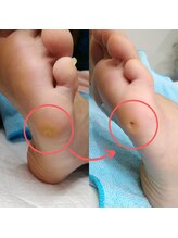 ドクターネイル爪革命 長野店/【たこ・うおのめ】リラク/足裏