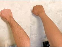 腕脱毛ビフォーアフターです。写真は15回照射後。脱毛期間3カ月
