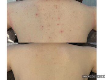 レイズ(RAISE)/ブライダル/ボディーピーリング