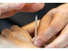 みわ整体鍼灸院/鍼灸の施術です