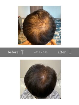 青空 天神大名店(SORA)/マイクロチップ頭皮 &nbsp;4回