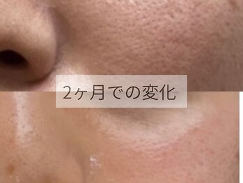 ジョーヌ(JAUNE)/お悩みNo.1・毛穴もお任せ