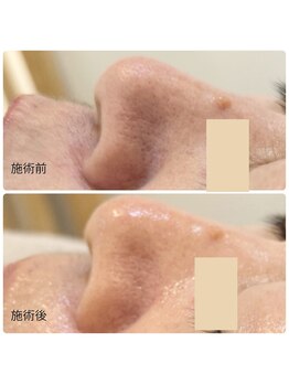 チョチョワンプラス(緒々one+)/小鼻つやピカ☆