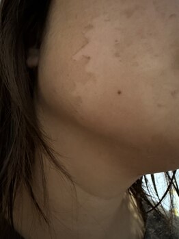 オリス(Oris)/グリーンピールシェド期間