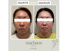 マカオン(machaon)の雰囲気（たるみ改善リフトでエイジングサインをケアして若々しい表情に）