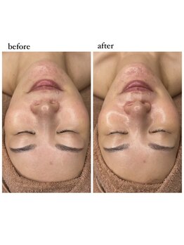 サロン ハリー(SALON HARRY)の写真/夏の日差しに負けない！輝く明るいお肌へ☆くすみ・しみケアで紫外線対策も万全◎