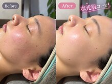 チャンティック (CANTIK)の雰囲気（#毛穴#艶肌#ハリ#シワ#水光肌へピーリングとPDRNサーモン導入）
