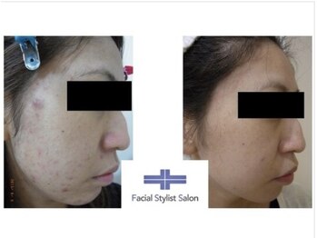 フェイシャルスタイリストサロン 四谷店/ケア例(38)