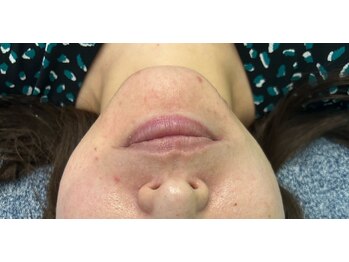 レイモード(Ray mode)/BBLフェイシャル＆パック