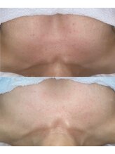 カランコエ(KALANCHOE)/ブライダル前のボディメンテにも