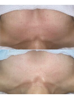 カランコエ(KALANCHOE)/ブライダル前のボディメンテにも