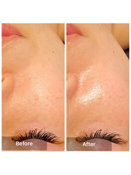 プライベートサロン アール(R)/FWT（顔脱毛）