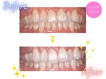 エクシアホワイト 立川南口店/ビフォーアフター
