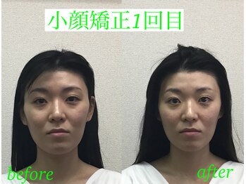 オズ六本木/小顔矯正ビフォーアフター