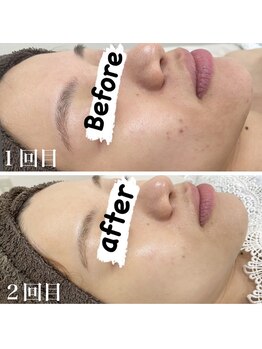 カルディエ(Cardie)/肌質改善　ビフォーアフター