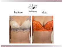 ベルビューティー(belle beauty)/バストアップ◇症例◇