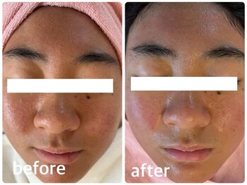 アズ(AZU)/●before after