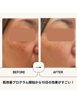 ボディトーン(bodytone)/肌改善プログラム実施中♪