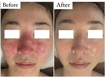 サロン アンス(anse)/ハーブピーリング