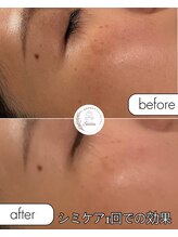 セゾン(Saison)/シミケア1回施術後