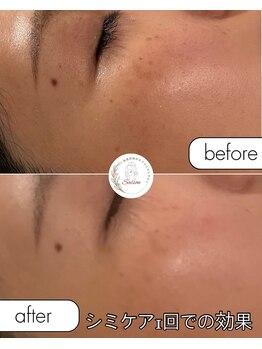 セゾン(Saison)/シミケア1回施術後