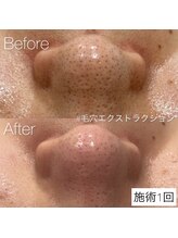 イリス(Iris)/毛穴エクストラクション！