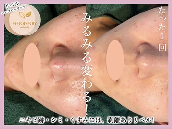 ハーバリー 天王寺(HERBERRY)/ハーブピーリング専門店HERBERRY
