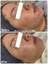 ブロッサム(Blossom)/ホワイトスノーピール7回目