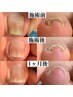 【フット】巻き爪補正4ヶ所￥22000～※予約前にブログの注意事項確認下さい