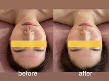 トナリ鍼灸院/【左右差、顔の歪み】美容鍼