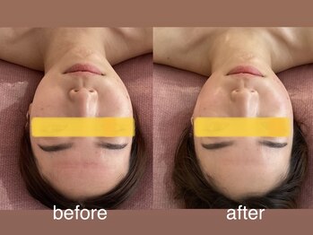 トナリ鍼灸院/【左右差、顔の歪み】美容鍼