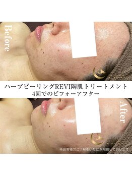 エスプリ 新宿店/ハーブピーリング新宿