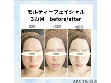 モルティー 広島店(Molti)/ブライダルエステ