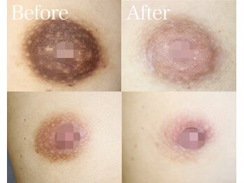 ライム 五反田(LIME)/ローマピンク|黒ずみケア