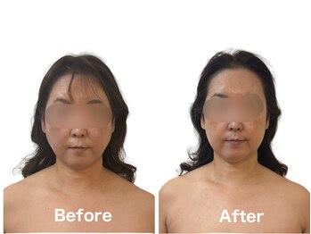 佳園/勝山式最高級小顔術