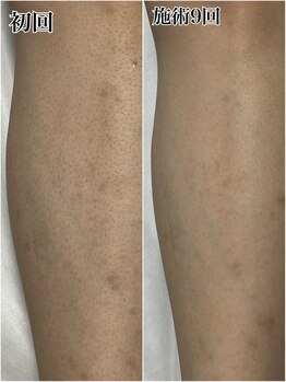 ルシャトン(Le Chaton)/あし脱毛