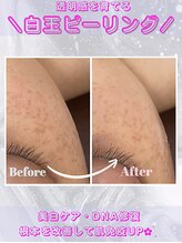 レイビス 盛岡店(RAYVIS)/肌管理ピーリング