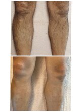 アイズ(I'Z)/足脱毛